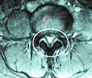 척추관 협착증 MRI