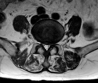 수술전 MRI 사진